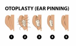 Otoplasty In turkey
