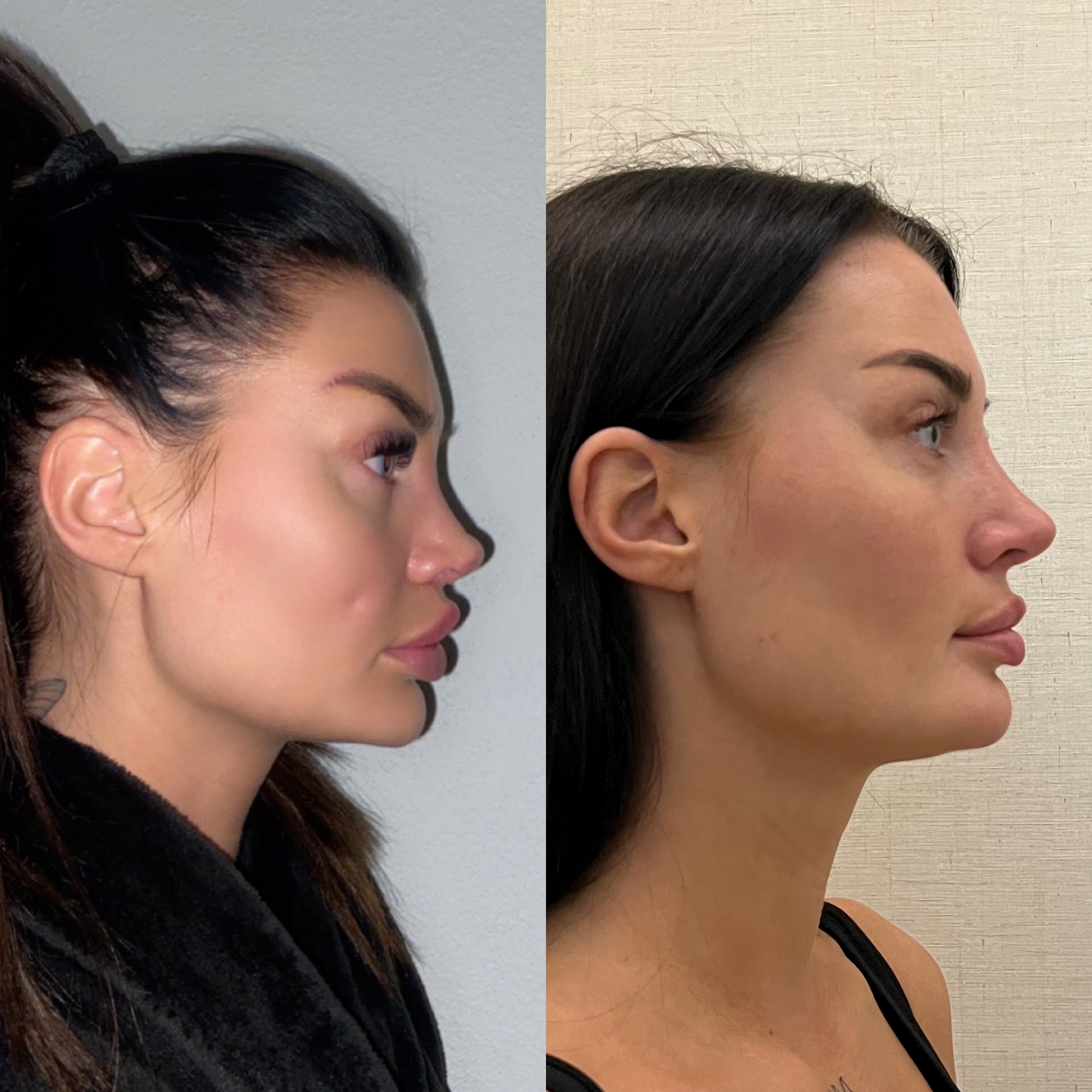 Eye brow lift fox eyes