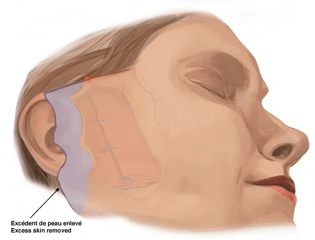 Deep Plane Facelift