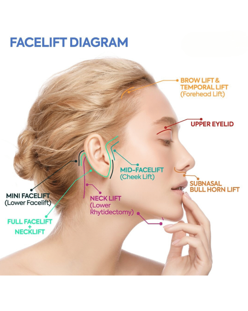 Facelift In Turkey