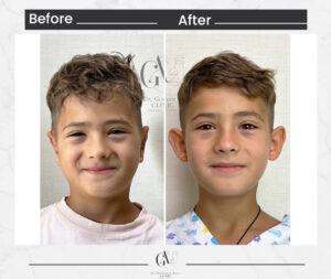 Otoplasty by Dr.Gorkem Atsal
