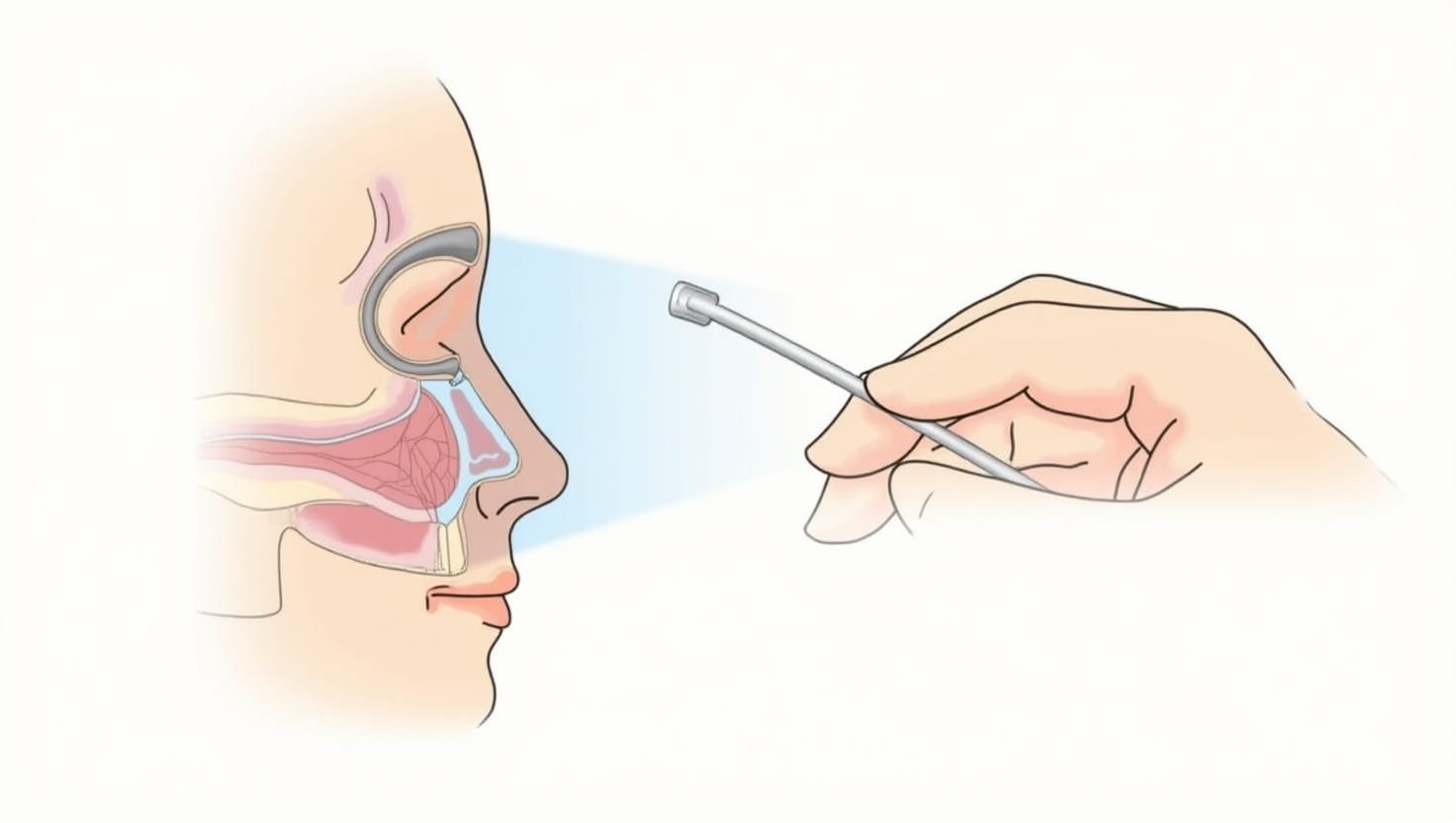 Balloon Sinuplasty Procedure Illustration